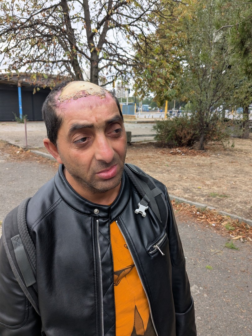 Alexander with his burns